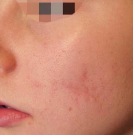 CO2 Laser Resurfacing Before and After - Case -1, Image 2 - Female, age 18 – 24 - Longmont, CO - Institute for Ageless Living