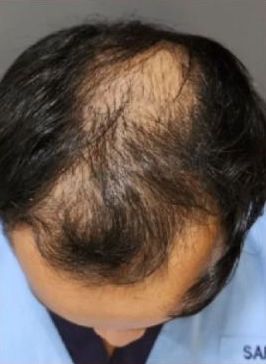 Non-Invasive Hair Restoration Before and After - Case -1, Image 1 - Male, age 35 – 44 - Longmont, CO - Institute for Ageless Living