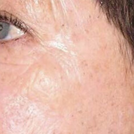 CO2 Laser Resurfacing Before and After - Case 2, Image 2 - Female, age 45 – 54 - Longmont, CO - Institute for Ageless Living