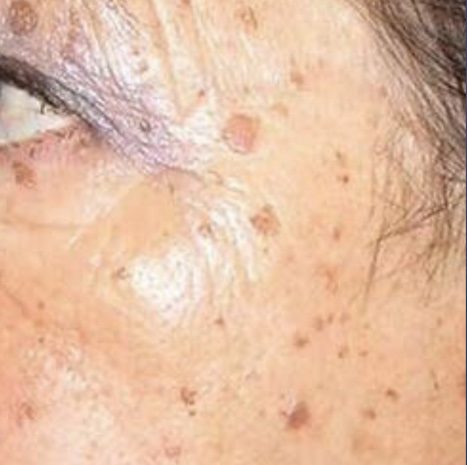 CO2 Laser Resurfacing Before and After - Case 2, Image 1 - Female, age 45 – 54 - Longmont, CO - Institute for Ageless Living