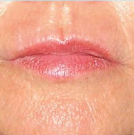 CO2 Laser Resurfacing Before and After - Case 3, Image 2 - Female, age 55 – 64 - Longmont, CO - Institute for Ageless Living