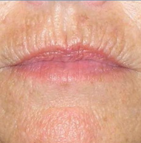 CO2 Laser Resurfacing Before and After - Case 3, Image 1 - Female, age 55 – 64 - Longmont, CO - Institute for Ageless Living