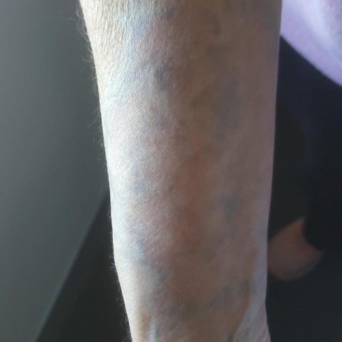 Laser Tattoo Removal Before and After - Case 2, Image 2 - Male, age 25 – 34 - Longmont, CO - Institute for Ageless Living