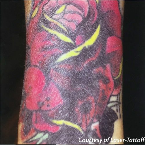 Laser Tattoo Removal Before and After - Case 2, Image 1 - Male, age 25 – 34 - Longmont, CO - Institute for Ageless Living
