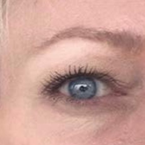 CO2 Laser Resurfacing Before & Afters | Institute for Ageless Living