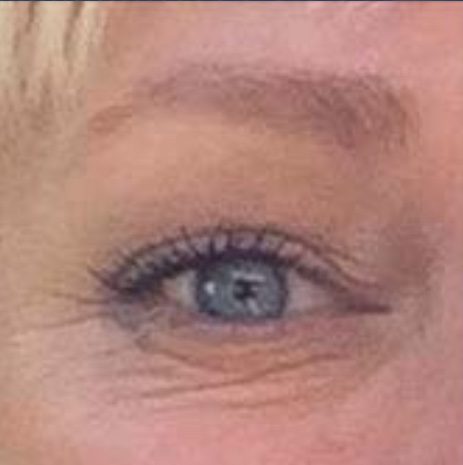 CO2 Laser Resurfacing Before & Afters | Institute for Ageless Living