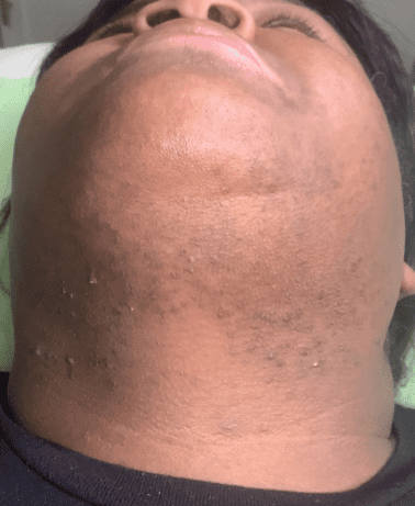 Laser Hair Removal Before and After - Case -1, Image 1 - Female, age 45 – 54 - Longmont, CO - Institute for Ageless Living