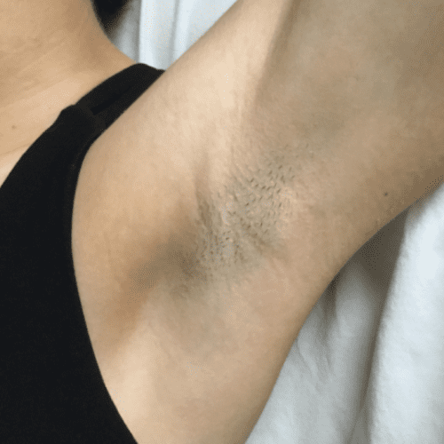 Laser Hair Removal Before and After - Case 2, Image 1 - Female, age 25 – 34 - Longmont, CO - Institute for Ageless Living
