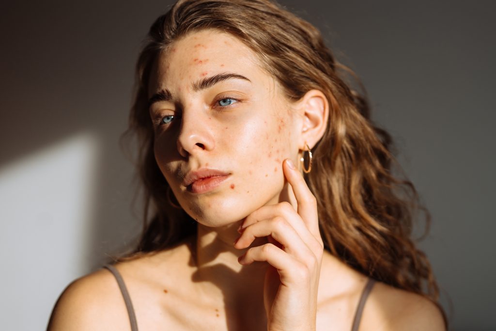 A young woman with long wavy hair and blue eyes touches her face, showing visible acne and blemishes on her cheeks and forehead. She wears a tank top and hoop earrings, with soft natural light illuminating her face—a candid moment that reflects both vulnerability and the importance of wellness, as promoted by the Institute For Ageless Living.