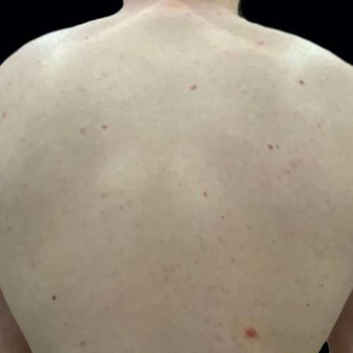 Medical-Grade Chemical Peels Before and After - Case chemicalpeels5, Image 2 - Female, age 25 – 34 - Longmont, CO - Institute for Ageless Living