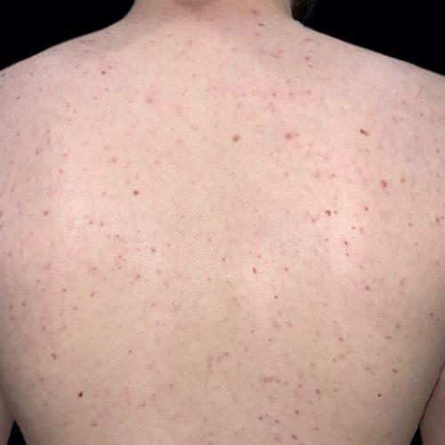Medical-Grade Chemical Peels Before and After - Case chemicalpeels5, Image 1 - Female, age 25 – 34 - Longmont, CO - Institute for Ageless Living