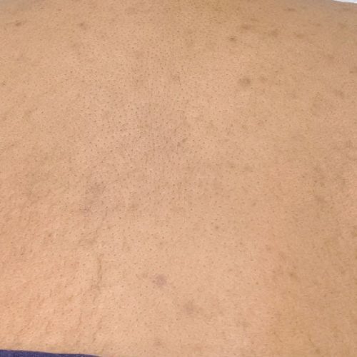 Medical-Grade Chemical Peels Before and After - Case chemicalpeels3, Image 2 - Female, age 25 – 34 - Longmont, CO - Institute for Ageless Living