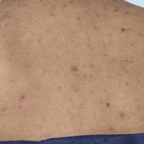 Medical-Grade Chemical Peels Before and After - Case chemicalpeels3, Image 1 - Female, age 25 – 34 - Longmont, CO - Institute for Ageless Living