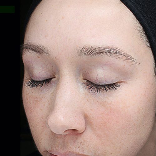 Medical-Grade Chemical Peels Before and After - Case chemicalpeels8, Image 2 - Female, age 18 – 24 - Longmont, CO - Institute for Ageless Living