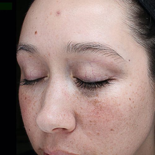 Medical-Grade Chemical Peels Before and After - Case chemicalpeels8, Image 1 - Female, age 18 – 24 - Longmont, CO - Institute for Ageless Living