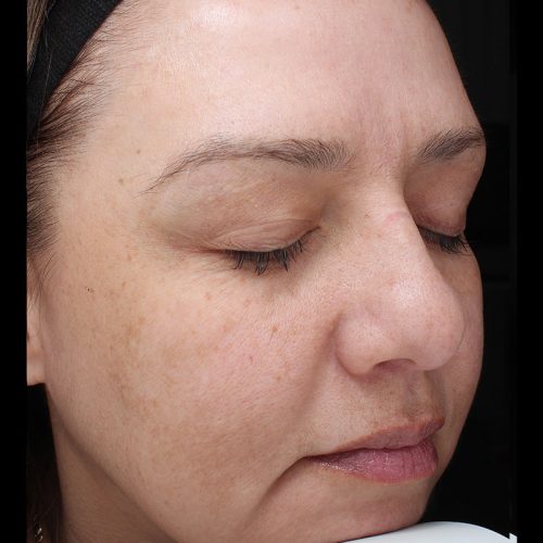 Medical-Grade Chemical Peels Before and After - Case chemicalpeels10, Image 2 - Female, age 45 – 54 - Longmont, CO - Institute for Ageless Living