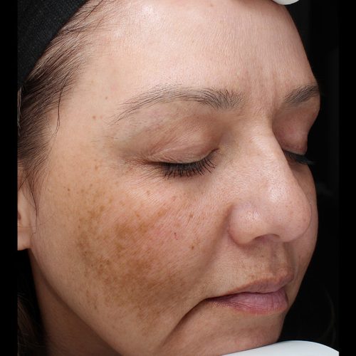 Medical-Grade Chemical Peels Before and After - Case chemicalpeels10, Image 1 - Female, age 45 – 54 - Longmont, CO - Institute for Ageless Living