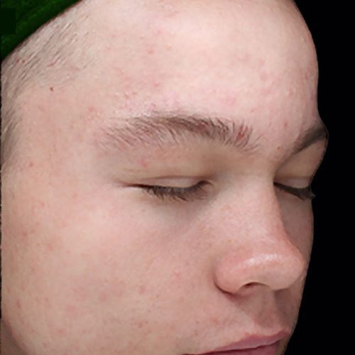 Medical-Grade Chemical Peels Before and After - Case chemicalpeels7, Image 2 - Female, age 18 – 24 - Longmont, CO - Institute for Ageless Living