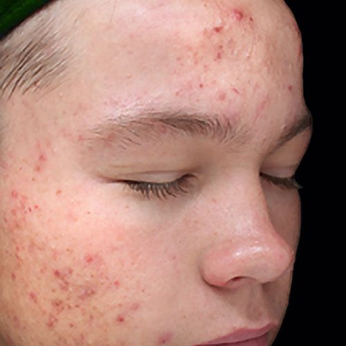 Medical-Grade Chemical Peels Before and After - Case chemicalpeels7, Image 1 - Female, age 18 – 24 - Longmont, CO - Institute for Ageless Living