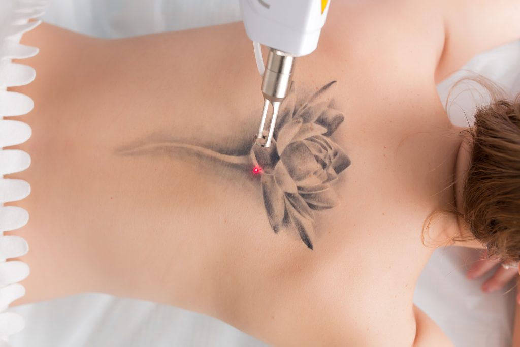 At the Institute For Ageless Living, a person lies face down receiving laser tattoo removal on a large black lotus flower tattoo on their upper back. A device emits a red light onto the tattoo, demonstrating a commitment to wellness and skin rejuvenation.