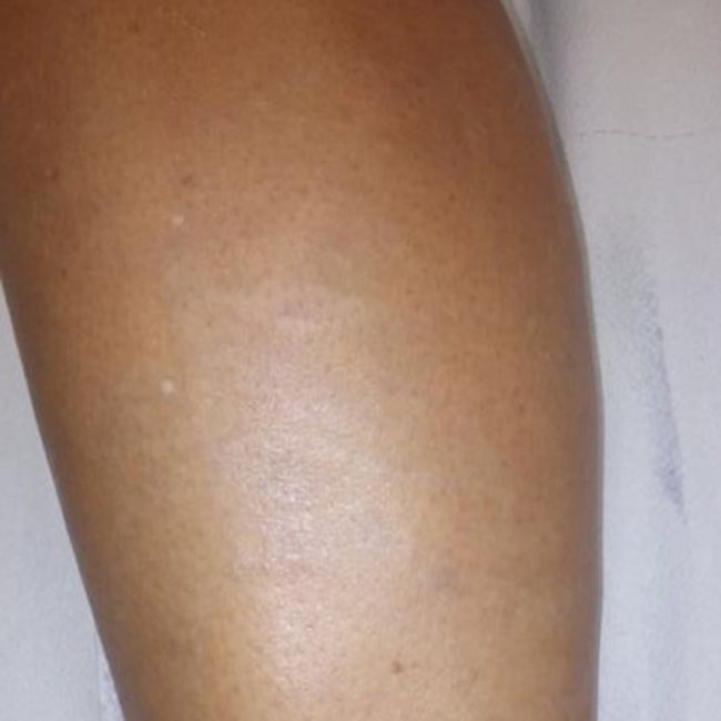 Laser Tattoo Removal Before & Afters | Institute for Ageless Living