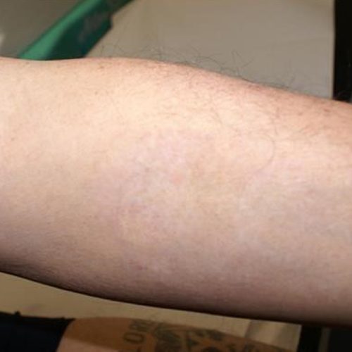 Laser Tattoo Removal Before and After - Case -1, Image 2 - Male, age 25 – 34 - Longmont, CO - Institute for Ageless Living
