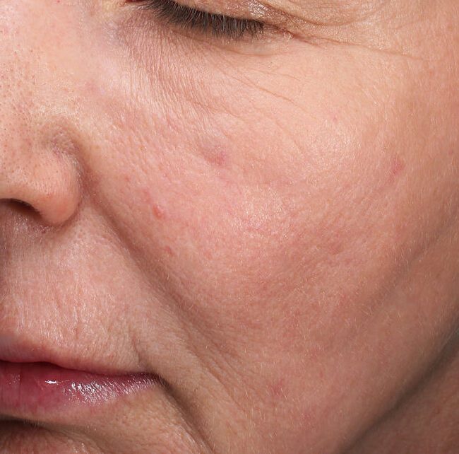 RF Microneedling Before & Afters | Institute for Ageless Living