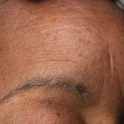 RF Microneedling Before and After - Case -1, Image 2 - Female, age 45 – 54 - Longmont, CO - Institute for Ageless Living
