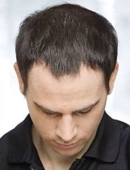 Non-Invasive Hair Restoration Before & Afters | Institute for Ageless Living