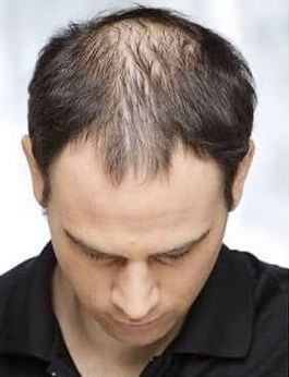 Non-Invasive Hair Restoration Before & Afters | Institute for Ageless Living