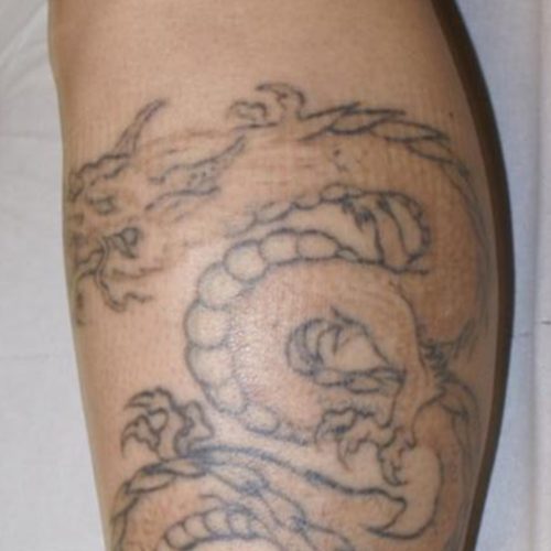 Laser Tattoo Removal Before and After - Case 3, Image 1 - Female, age 35 – 44 - Longmont, CO - Institute for Ageless Living