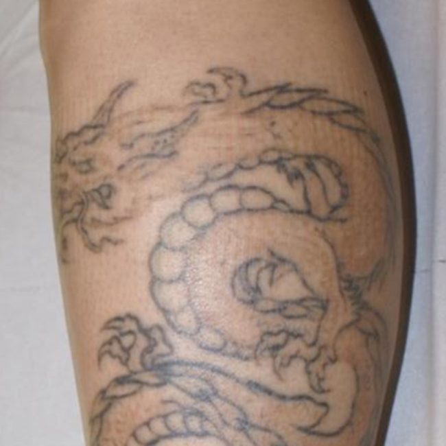 Laser Tattoo Removal Before & Afters | Institute for Ageless Living