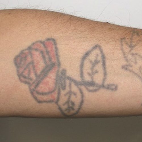 Laser Tattoo Removal Before and After - Case -1, Image 1 - Male, age 25 – 34 - Longmont, CO - Institute for Ageless Living