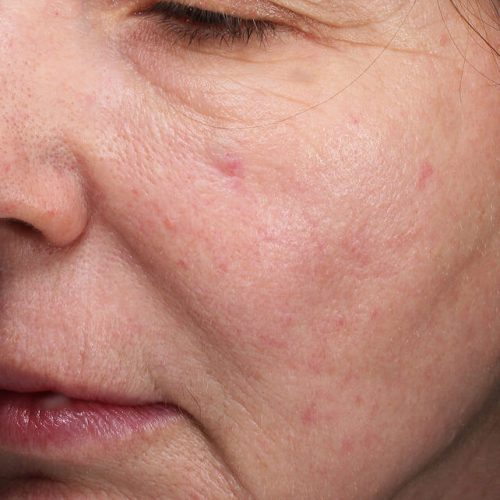 RF Microneedling Before and After - Case 2, Image 1 - Female, age 45 – 54 - Longmont, CO - Institute for Ageless Living