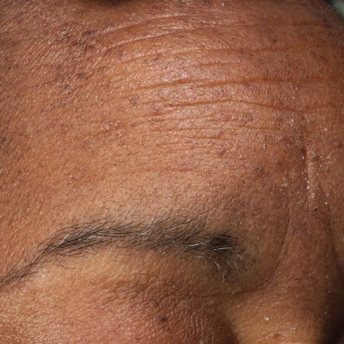 RF Microneedling Before and After - Case -1, Image 1 - Female, age 45 – 54 - Longmont, CO - Institute for Ageless Living