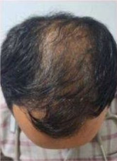 Non-Invasive Hair Restoration Before and After - Case -1, Image 2 - Male, age 35 – 44 - Longmont, CO - Institute for Ageless Living