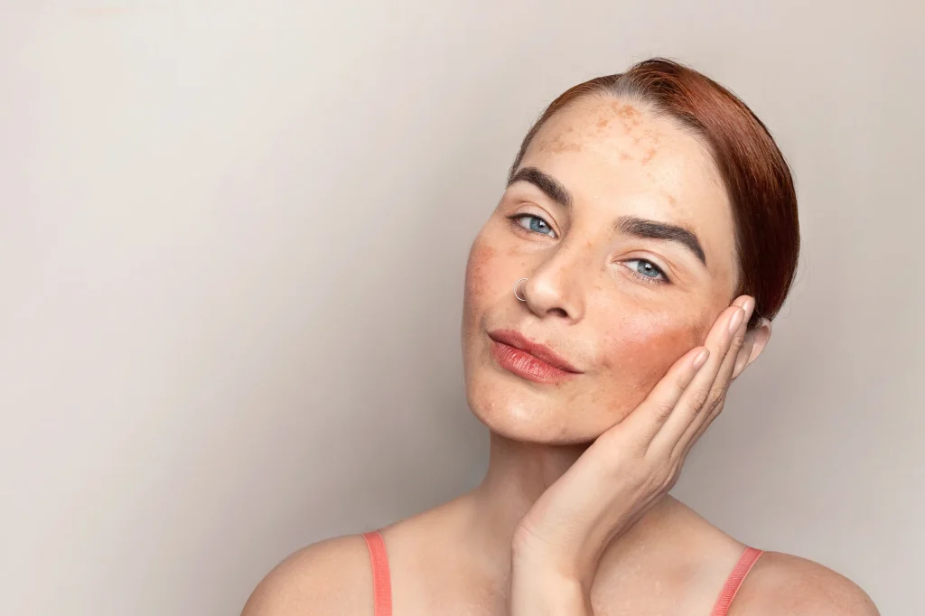 A woman with fair skin and visible hyperpigmentation touches her face gently, looking confidently at the camera against a neutral background—a portrait that embodies wellness and self-assurance, inspired by the Institute For Ageless Living's approach to anti-aging care.