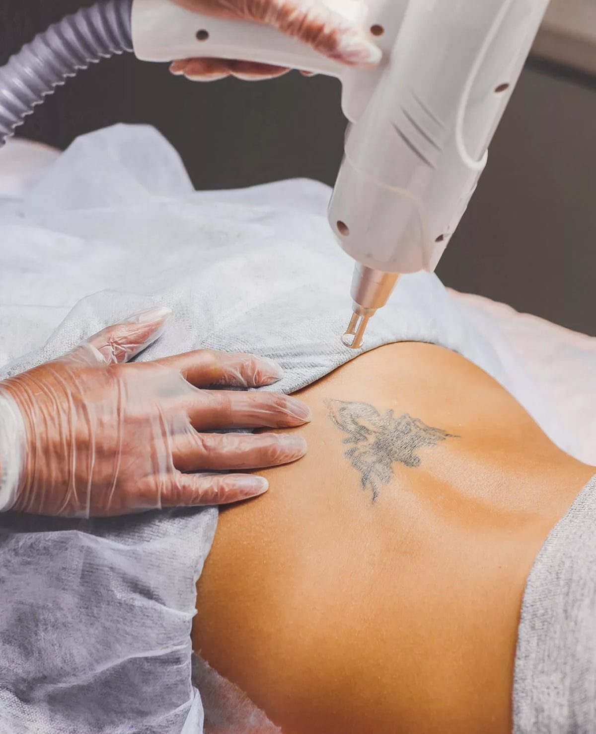 A person wearing gloves uses a laser device to remove a butterfly tattoo from someone's lower back at the Institute For Ageless Living. The tattoo is partially faded, and a protective sheet covers the surrounding area, reflecting the institute's commitment to wellness and advanced anti-aging treatments.