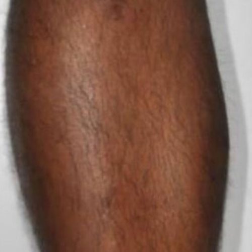 Laser Hair Removal Before and After - Case 3, Image 1 - Male, age 25 – 34 - Longmont, CO - Institute for Ageless Living