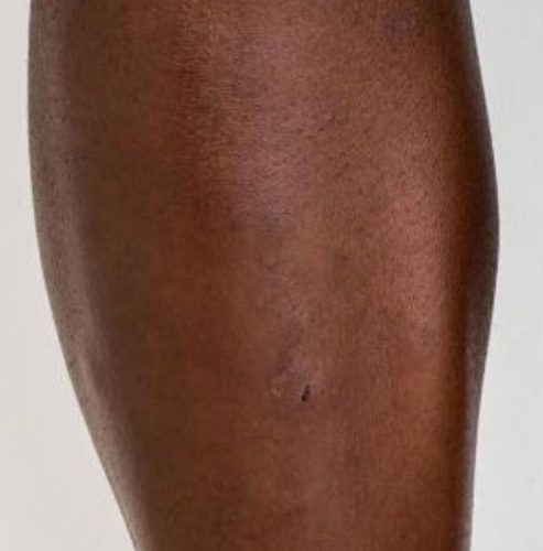 Laser Hair Removal Before and After - Case 3, Image 2 - Male, age 25 – 34 - Longmont, CO - Institute for Ageless Living