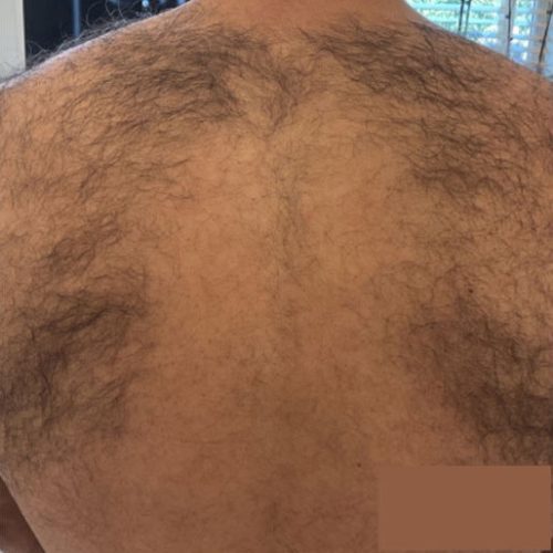 Laser Hair Removal Before and After - Case 4, Image 1 - Male, age 25 – 34 - Longmont, CO - Institute for Ageless Living