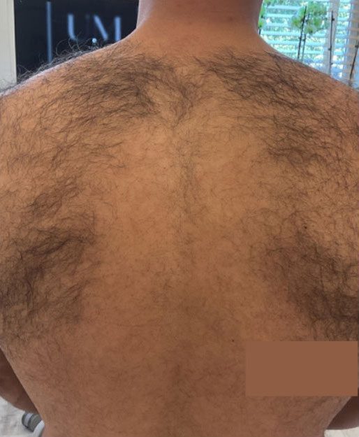 Laser Hair Removal Before & Afters | Institute for Ageless Living