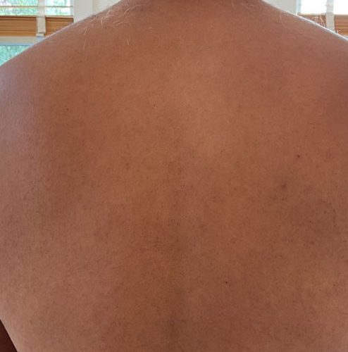 Laser Hair Removal Before and After - Case 4, Image 2 - Male, age 25 – 34 - Longmont, CO - Institute for Ageless Living