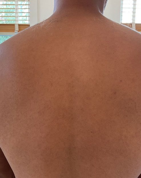 Laser Hair Removal Before & Afters | Institute for Ageless Living