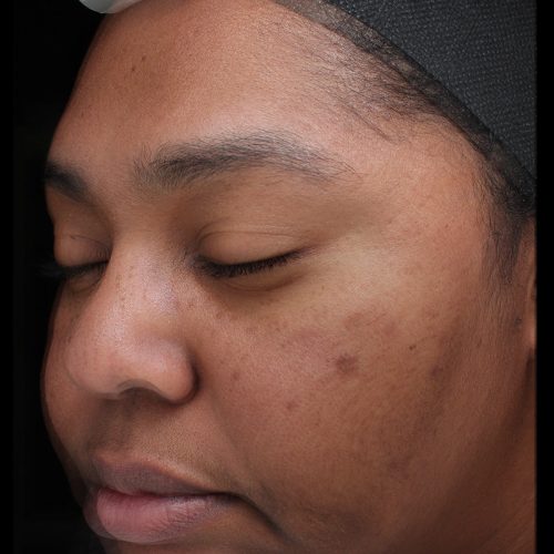 Medical-Grade Chemical Peels Before and After - Case chemicalpeels9, Image 2 - Female, age 18 – 24 - Longmont, CO - Institute for Ageless Living