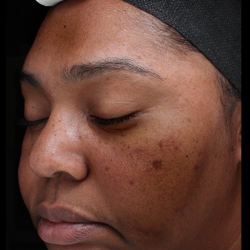 Medical-Grade Chemical Peels Before and After - Case chemicalpeels9, Image 1 - Female, age 18 – 24 - Longmont, CO - Institute for Ageless Living
