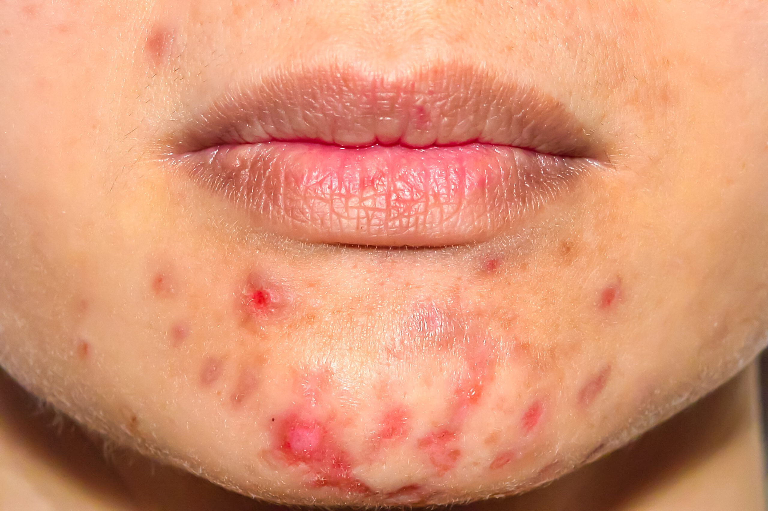 Close-up of a person's lower face showing inflamed red acne and pimples on the chin, surrounded by some brownish spots and uneven skin tone. Lips and part of the cheeks are visible, highlighting the challenges addressed at the Institute For Ageless Living—a center dedicated to wellness and anti-aging solutions.
