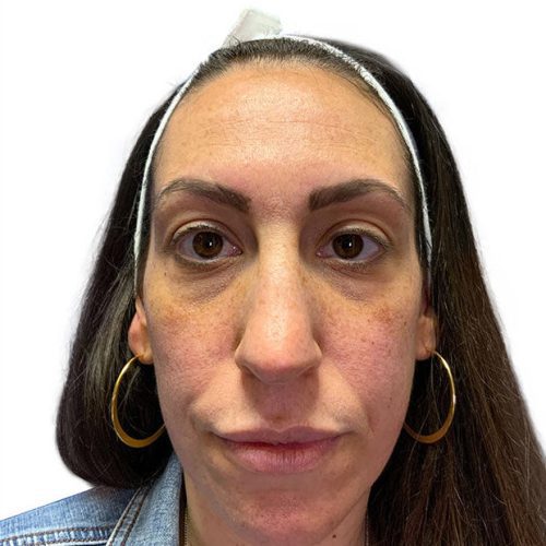 Medical-Grade Chemical Peels Before and After - Case chemicalpeels2, Image 1 - Female, age 35 – 44 - Longmont, CO - Institute for Ageless Living