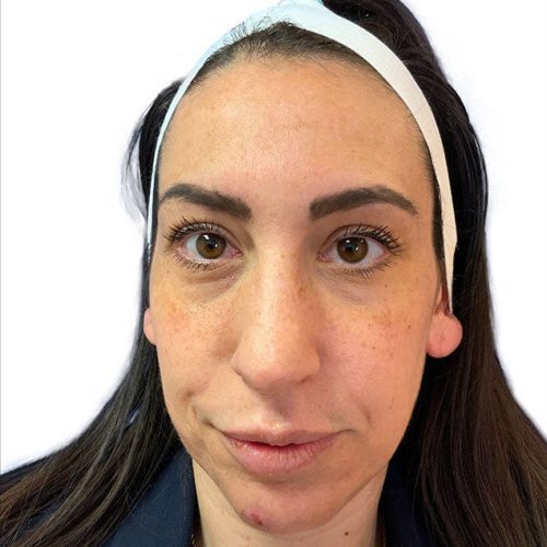 Medical-Grade Chemical Peels Before and After - Case chemicalpeels2, Image 2 - Female, age 35 – 44 - Longmont, CO - Institute for Ageless Living