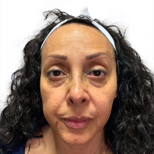 Medical-Grade Chemical Peels Before and After - Case chemicalpeels, Image 1 - Female, age 35 – 44 - Longmont, CO - Institute for Ageless Living